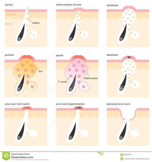 acne-formation-process-different-types-bumps-scars-bumps-blackheads-whiteheads-papule-pustules-scars-68322579.jpg